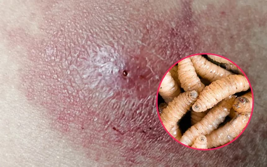 Puebla registra 5 casos de gusano barrenador en humanos