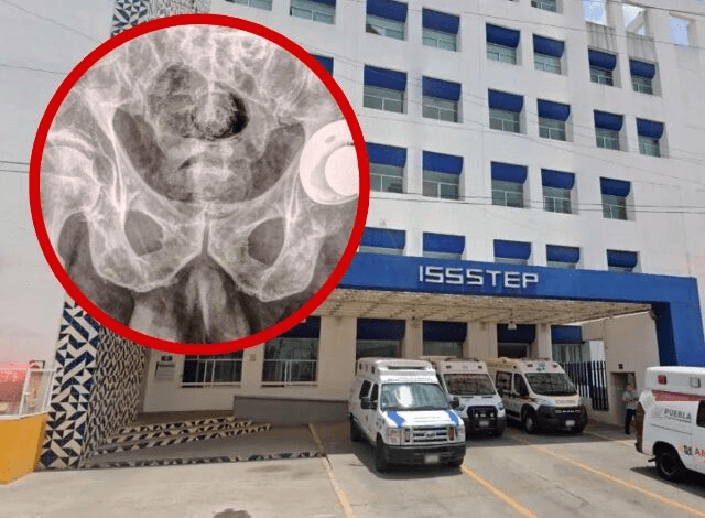 Coloca ISSSTEP con éxito primera prótesis de cadera sin costo