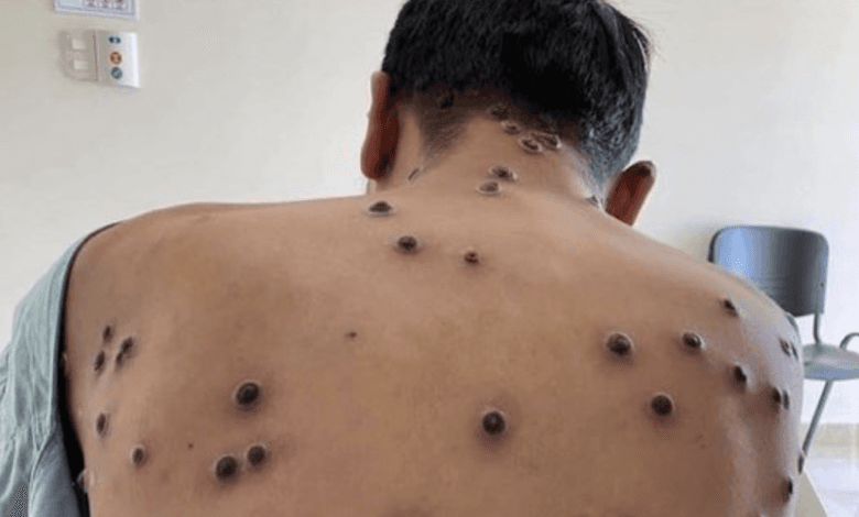 OMS levanta emergencia sanitaria por viruela del mono