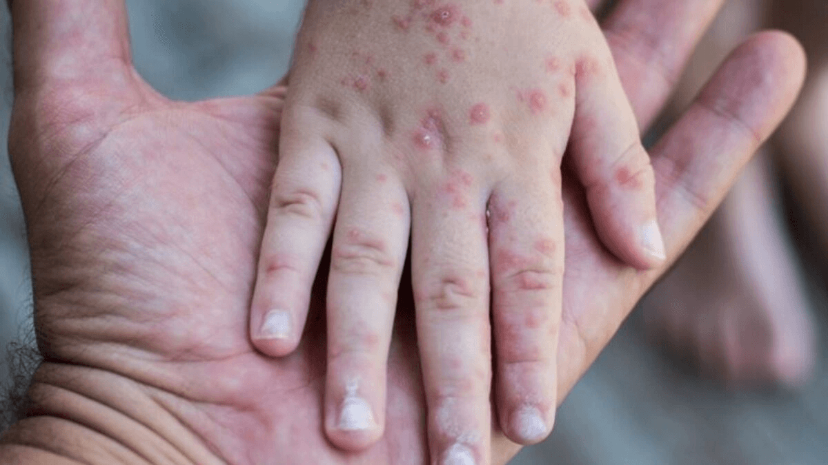 Suspenden clases presenciales en dos escuelas de Puebla por brote de Coxsackie