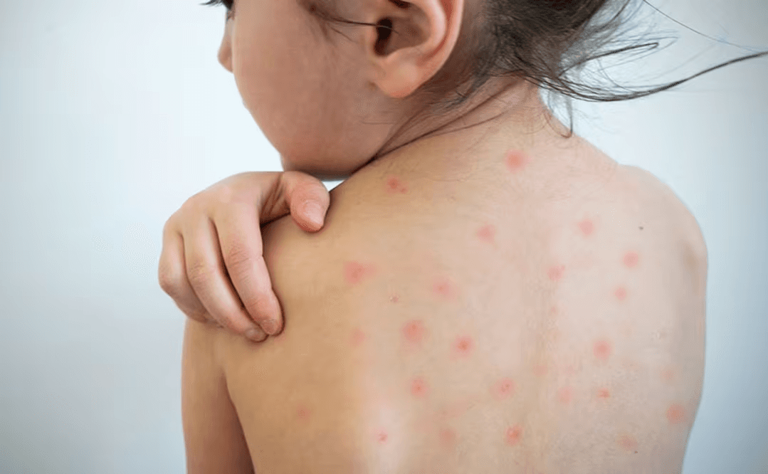 CDMX confirma la primera muerte por sarampión… pero ocurrió en 2025