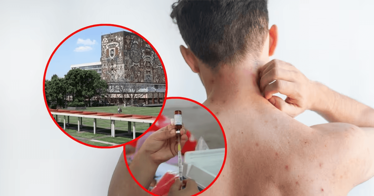 UNAM intensifica vacunación vs sarampión tras caso sospechoso